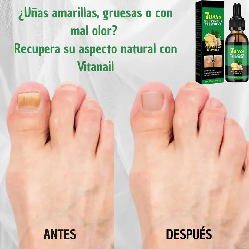 Clara‑Pure™ – Esencia Antihongos para Uñas
