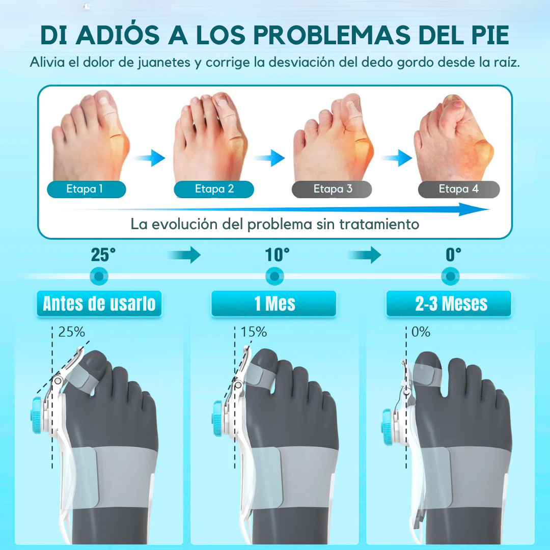 Corrector Plus™ – Alineador Ortopédico para Juanetes | Alivia el Dolor y Corrige sin Cirugía