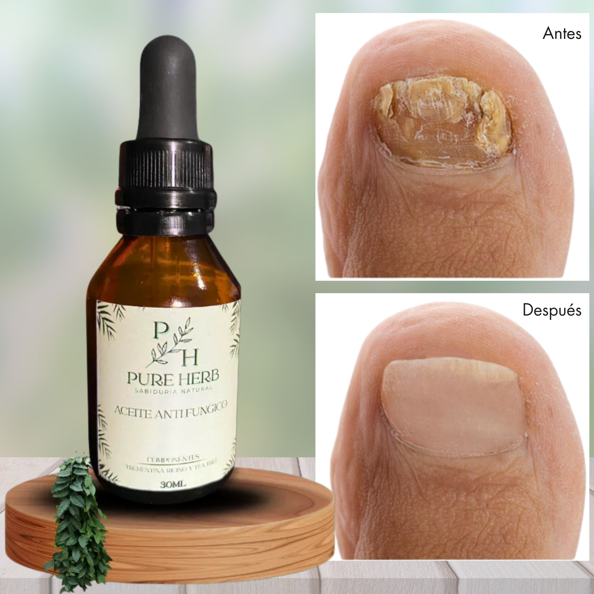 Aceite Antihongos Natural – Tratamiento para Uñas