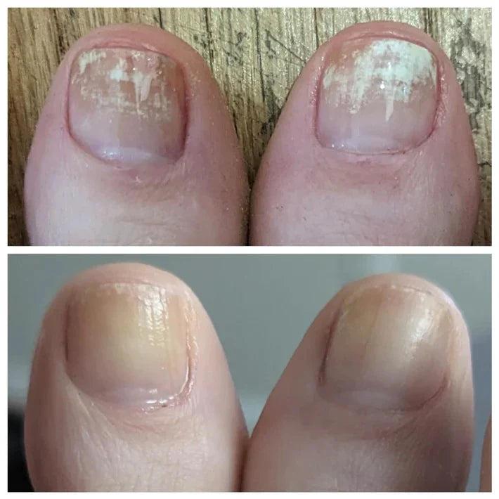 Aceite Antihongos Natural – Tratamiento para Uñas