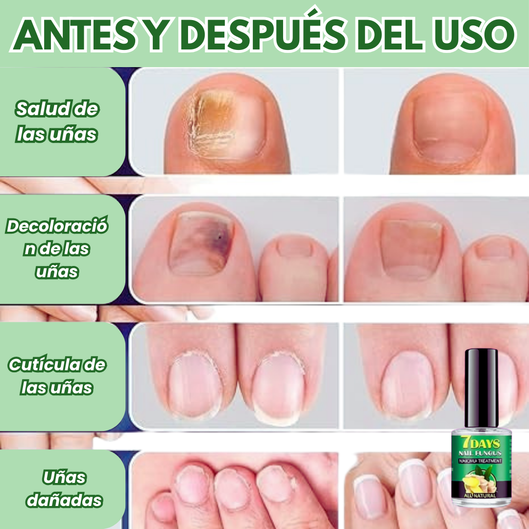 Clara‑Pure™ – Esencia Antihongos para Uñas