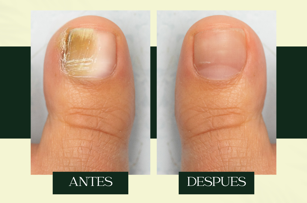 Aceite Antihongos Natural – Tratamiento para Uñas